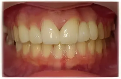前歯の歯並びをセラミッククラウンで改善