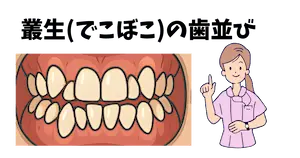 叢生(そうせい:でこぼこの歯並び)の治し方 2 叢生(でこぼこ)の歯並び