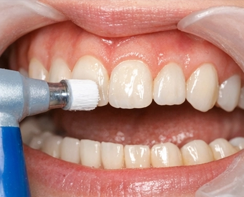 歯のクリーニングと乾燥